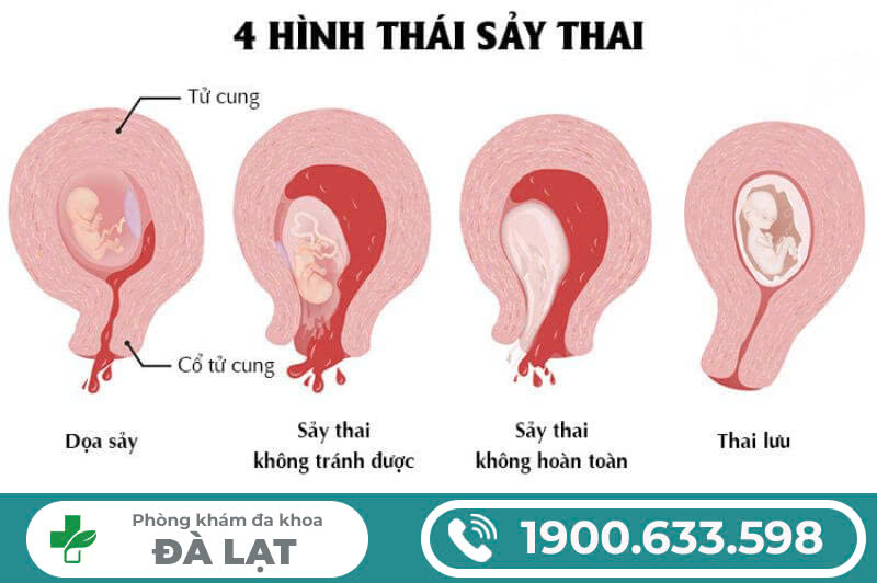 SẢY THAI: DẤU HIỆU NHẬN BIẾT VÀ CÁCH ĐIỀU TRỊ 